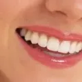 Cara Mencegah Gigi Berlubang dengan 6 Tips Ini