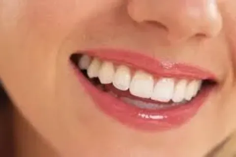 Cara Mencegah Gigi Berlubang dengan 6 Tips Ini
