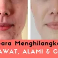 Menghilangkan Jerawat Alami