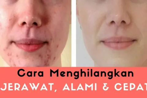 Menghilangkan Jerawat Alami