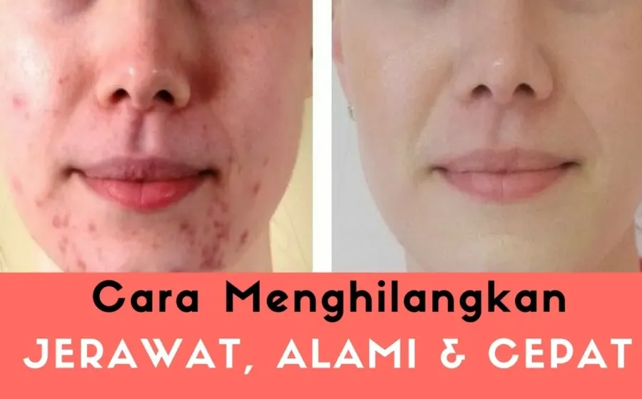 Menghilangkan Jerawat Alami