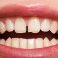 Inilah Penyebab Diastema dan Cara Mengatasinya yang Perlu Diketahui