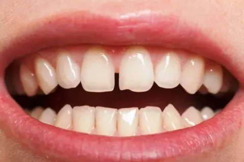 Inilah Penyebab Diastema dan Cara Mengatasinya yang Perlu Diketahui