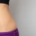 Ini Dia Cara Menghilangkan Stretch Mark Secara Alami