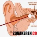 Mengambil Kapas Cotton Bud Tertinggal di Telinga